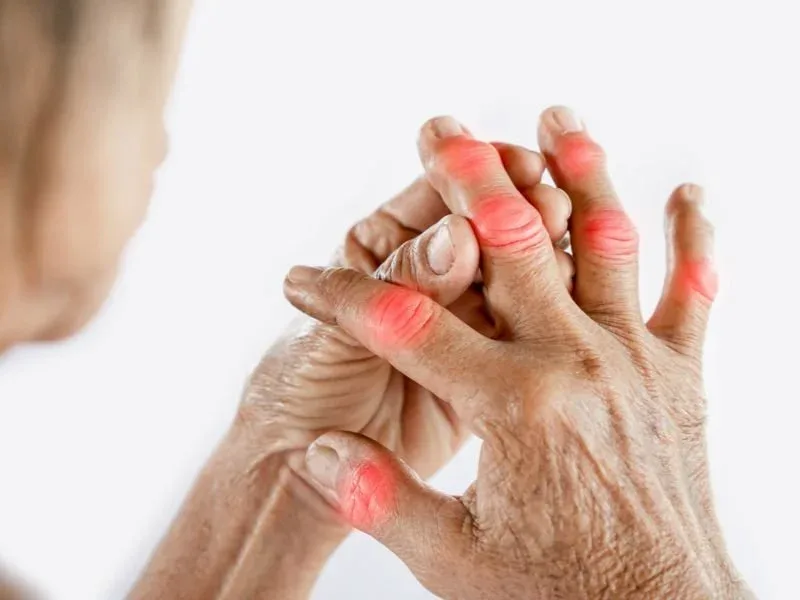 Classic Signs of Inflammation in the Body