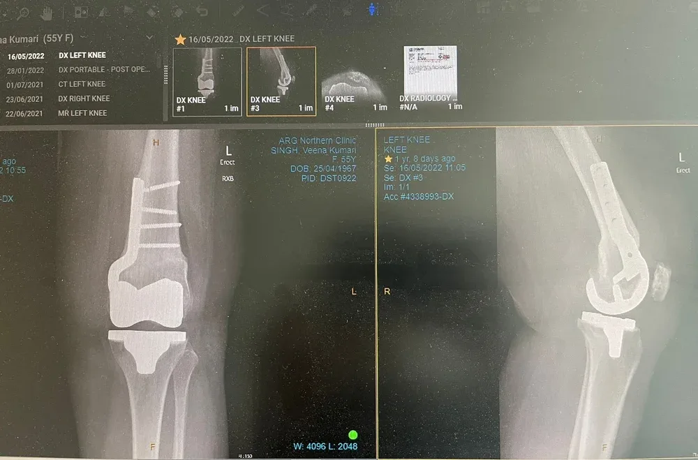 X-ray image of a left knee showing bones and joint structure.